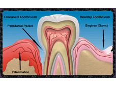 Peridontal Disease